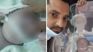 Photo of Woman gives birth to one-eyed baby in Yemen