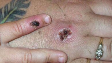 Photo of Canada, Australia among fresh countries to report Monekypox cases