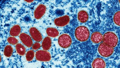 Photo of Turkish passenger with rashes not a Monkeypox case