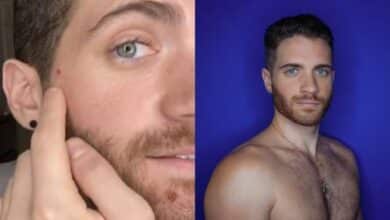 Photo of American actor Matt Ford confirms monkeypox diagnosis, first person ever with infection to go public | Video